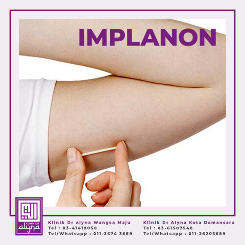 perkhidmatan-implanon