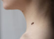 melanoma, skin tag, ketuat