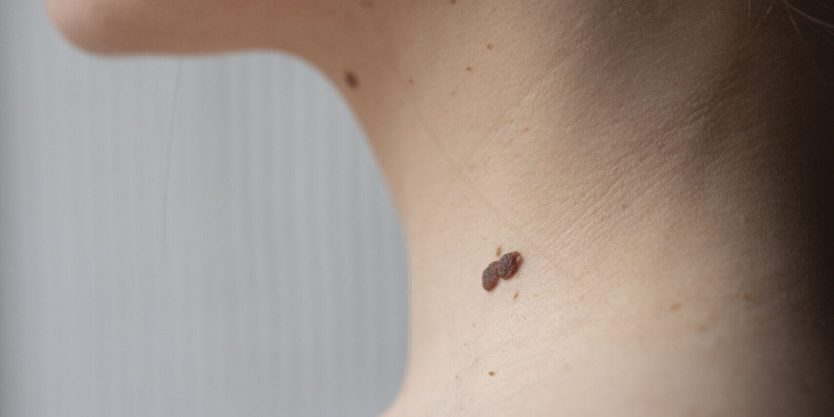 melanoma, skin tag, ketuat