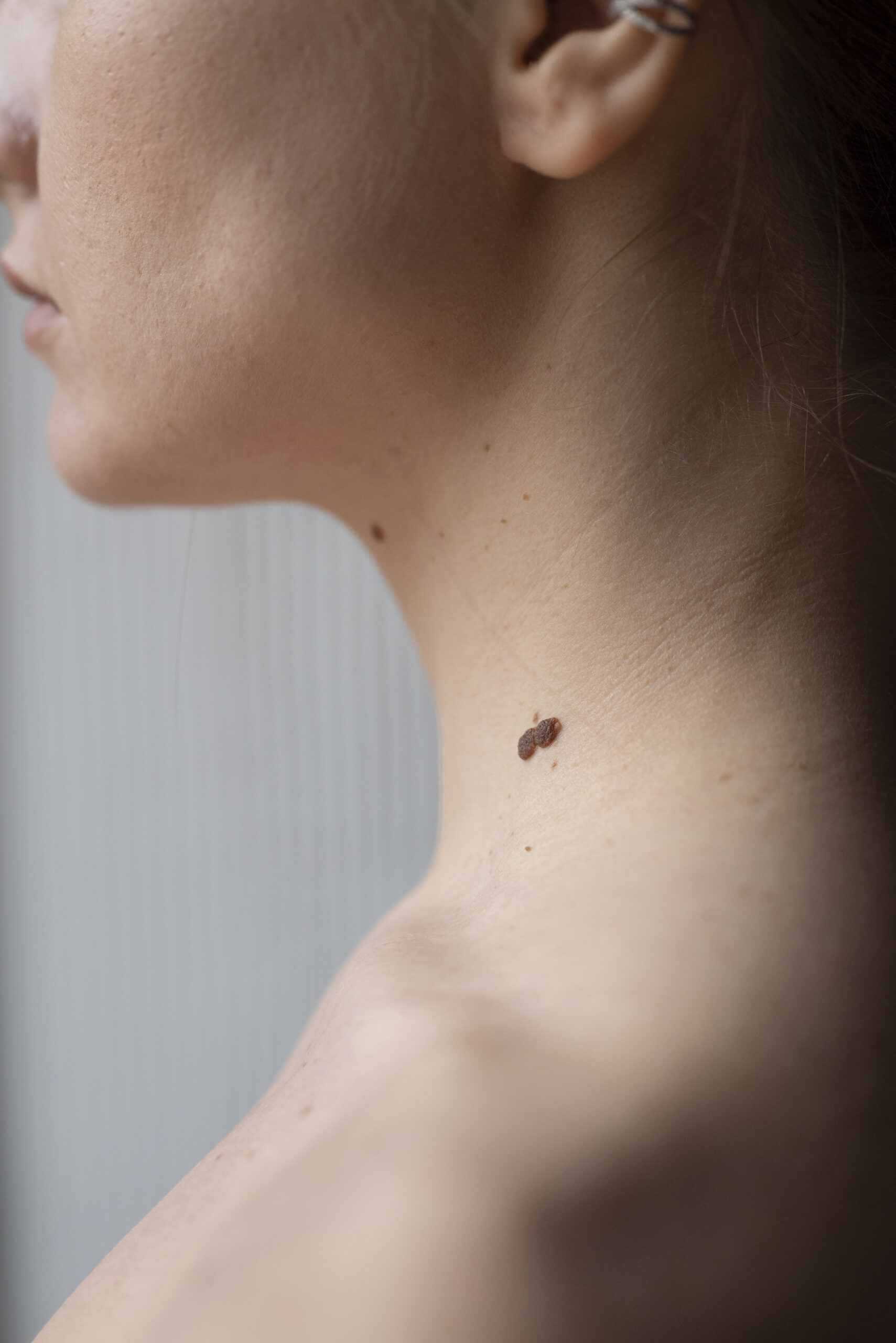 melanoma, skin tag, ketuat melanoma, skin tag, ketuat