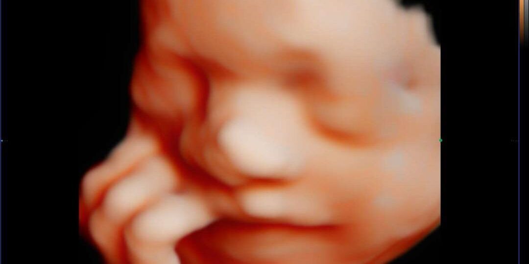 Pregnancy Scan 4D5D Jelas Comel di klinik Pregnancy Scan 4D5D Jelas Comel di klinik
