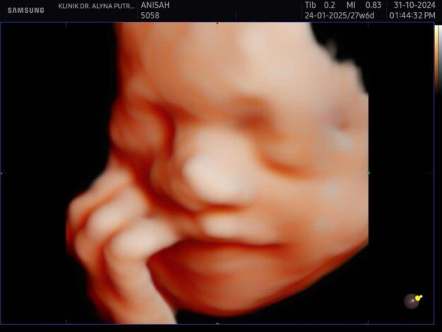 Pregnancy Scan 4D5D Jelas Comel di klinik