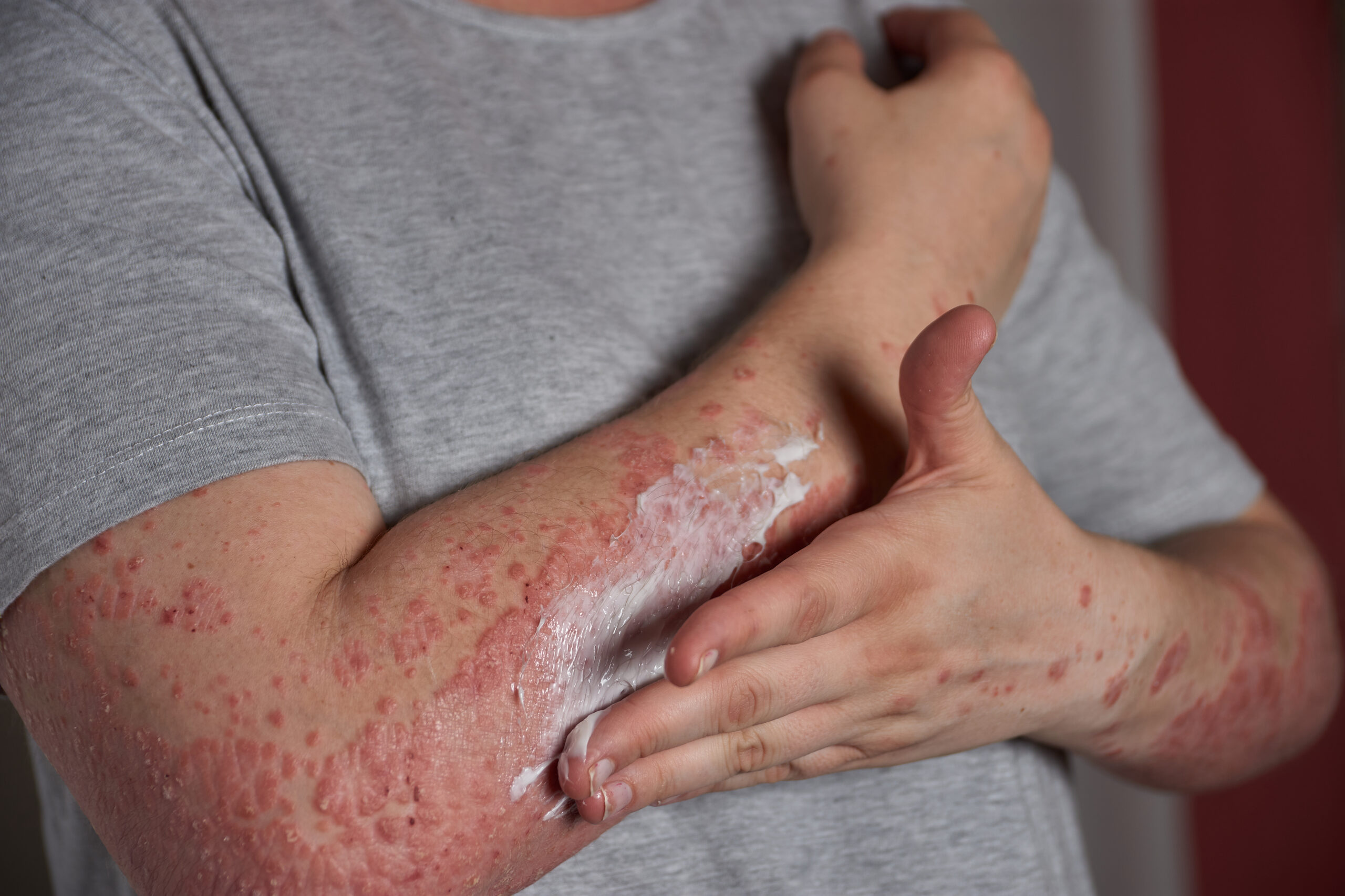 allergy rashed, sesak nafas dan panas badan