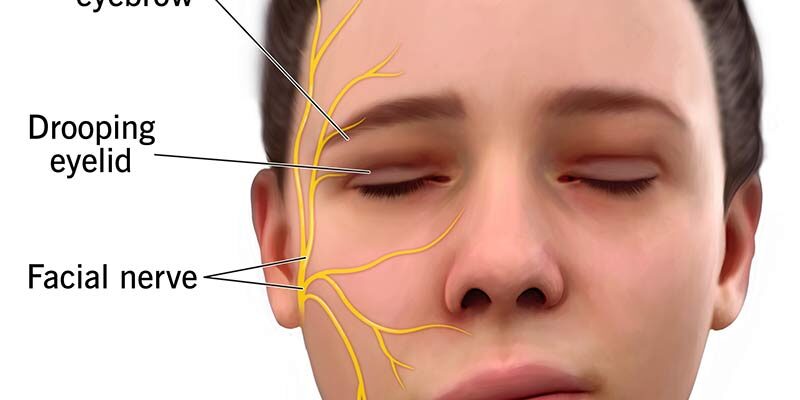 bells-palsy-muka-herot bells-palsy-muka-herot