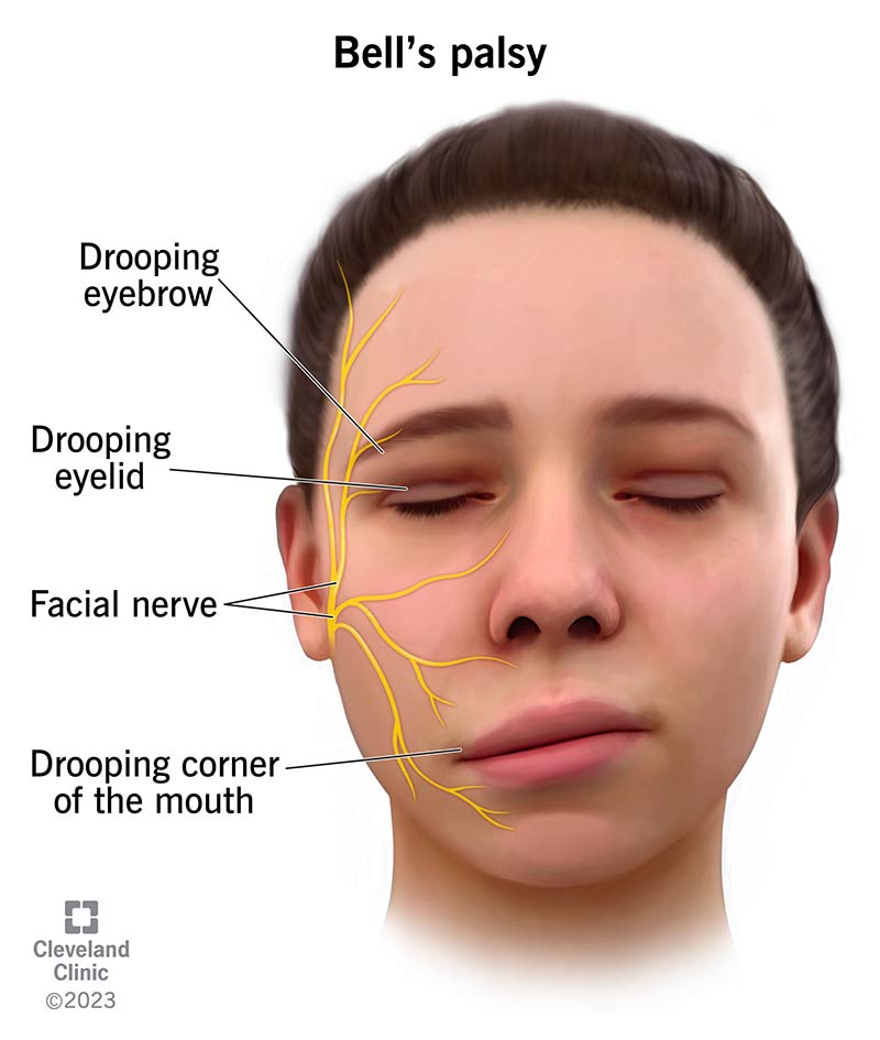 bells-palsy-muka-herot