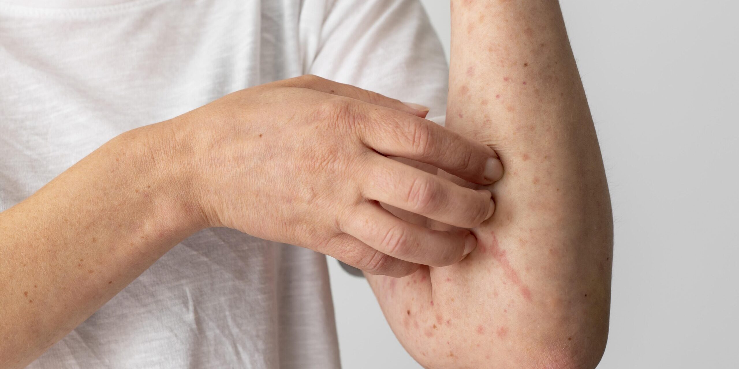 skin allergy ruam alahan wet therapy