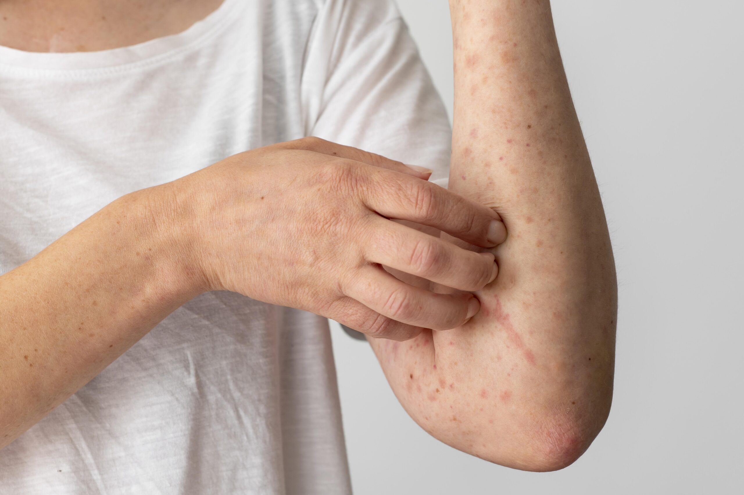 skin allergy ruam alahan wet therapy