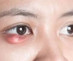 rawat ketumbit atau stye